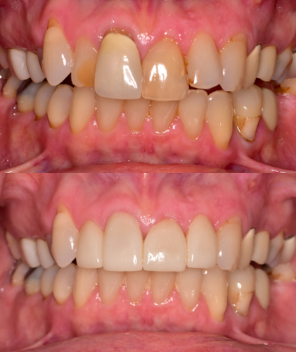 Four porcelain crowns to replace old, failing existing restorations