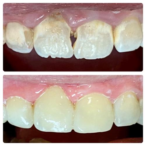 Extensive tooth decay restored same day by using composite bonding. 