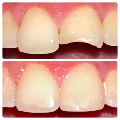 Composite bonding to restore a fractured front tooth