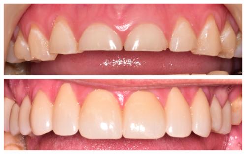 Full mouth rehabilitation to address a severe grinding habit