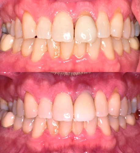 This dental implant restoration perfectly replaces a fractured tooth